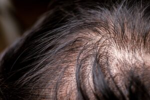 Hair Growth Cycles Phases and Age-Related Changes